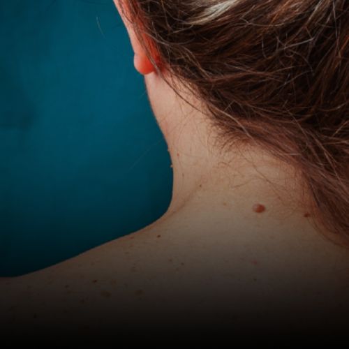 Black Patches & Facial Melanosis Treatment in Borivali, Mumbai at Skinzone Clinics