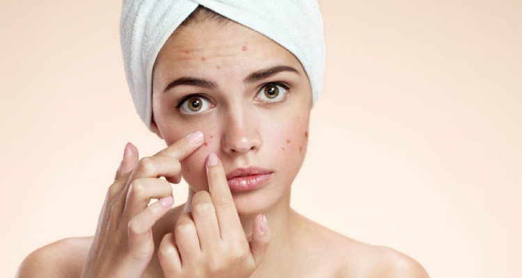Acne & Acne Marks & Scars Treatment in Kandivali, Mumbai at Skinzone Clinics