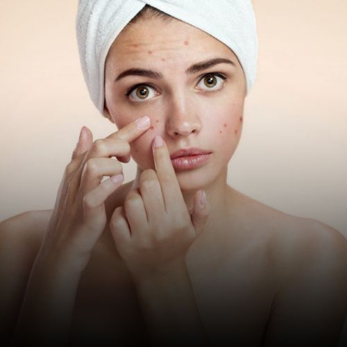 Acne & Acne Marks & Scars Treatment in Borivali, Mumbai at Skinzone Clinics