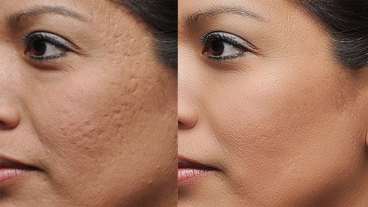 Treatment for Different Greades of Acne in Kandivali, Mumbai at Skinzone Clinics