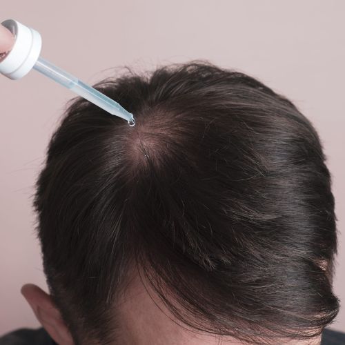 Hair Loss Treatment for Men in Borivali, Mumbai at Skinzone Clinics