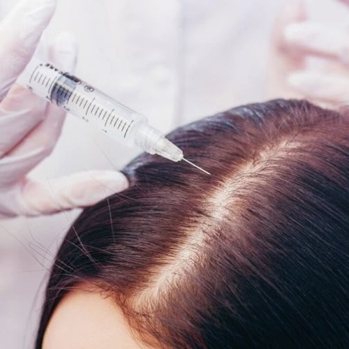 Treatment for Alopecia Areata in Borivali, Mumbai at Skinzone Clinics