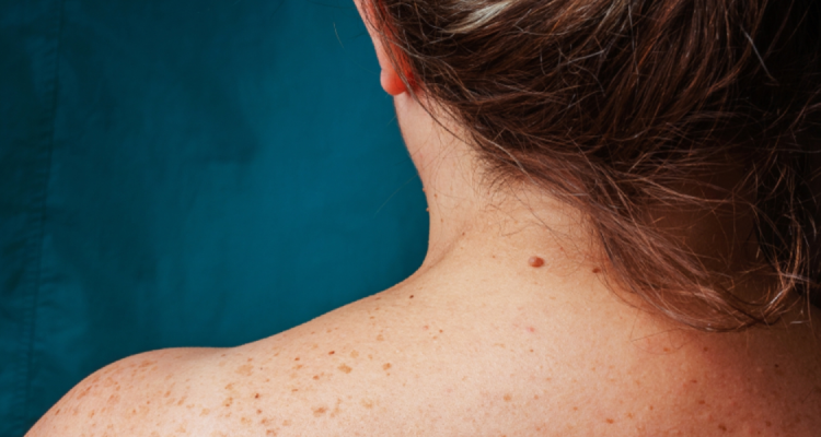 Black patches & Facial Melanosis Treatment in Borivali at Skinzone Clinics