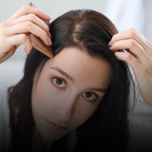 Dandruff Treatment in Borivali, Mumbai at Skinzone Clinics