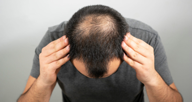 Hair Loss Treatment for Men in Borivali, Mumbai at Skinzone Clinics