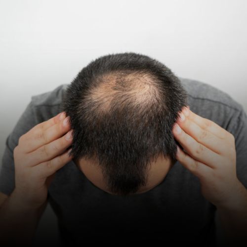 Hair Loss Treatment for men in Borivali, Mumbai at Skinzone Clinics