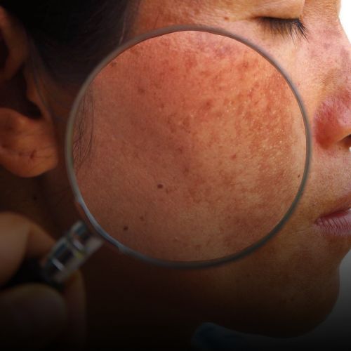 Laser for Pigmentation Treatment in Borivali at Skinzone Clinics