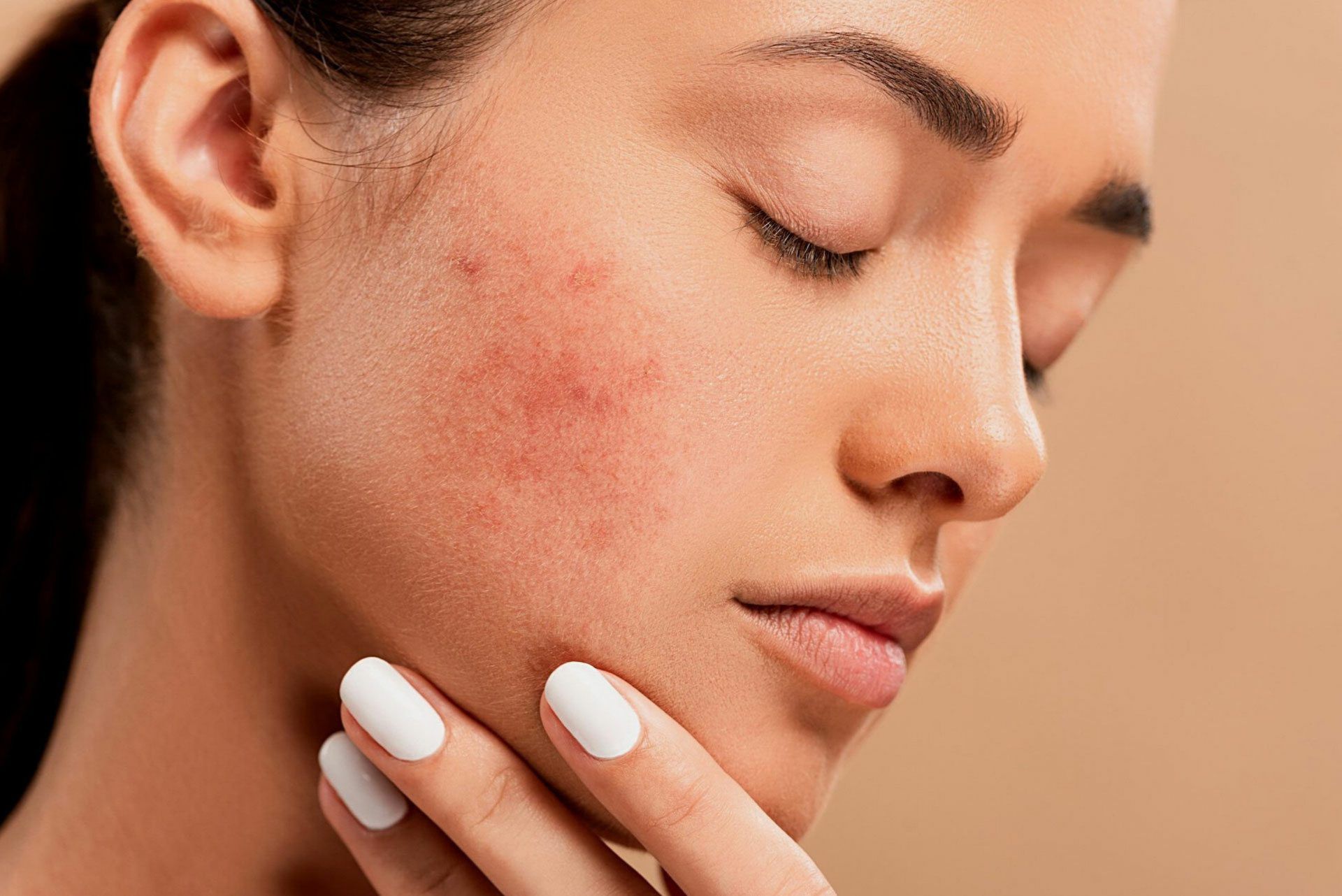 Treatment for Different Types of Acne in Kandivali, Mumbai at Skinzone Clinics