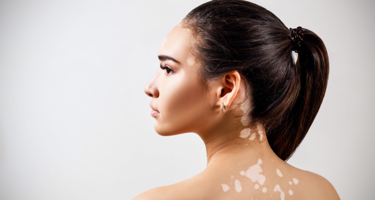 Vitiligo Treatment in Borivali, Mumbai at Skinzone Clinics