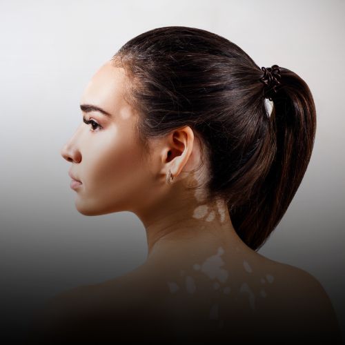 Vitiligo Treatment in Borivali, Mumbai at Skinzone Clinics